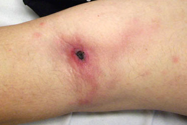 sepsis infection wound